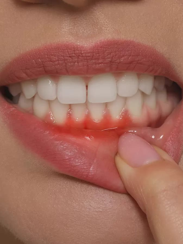 Which vitamin deficiency causes gum bleeding and why?