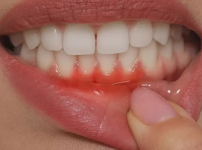 Which vitamin deficiency causes gum bleeding and why?
